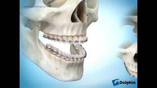 Avanço Maxilar Paciente Classe3 Cirurgia Ortognática [upl. by Ahseekat383]