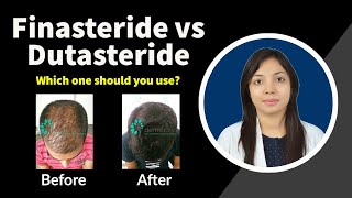 Finasteride vs Dutasteride Which is better  Finasteride and Dutasteride Side Effects [upl. by Jodie644]