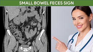 Small Bowel Feces Sign  Small Bowel Obstruction  CT Abdomen [upl. by Dugald]