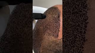 First Hair Wash After Hair Transplant Expert Tips  Dadu Medical Centre [upl. by Nagear]