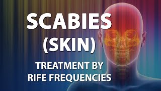 Scabies Skin  RIFE Frequencies Treatment  Energy amp Quantum Medicine with Bioresonance [upl. by Zennas]