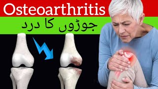 Osteoarthritis in HindiUrdu Symptoms Causes and Treatmentquot ऑस्टियोआर्थराइटिस [upl. by Brewster487]