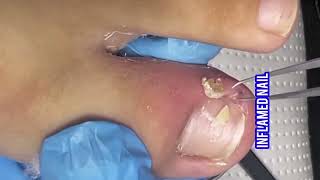 Inflamed Nail And Dry Skin Triming [upl. by Anegroeg826]