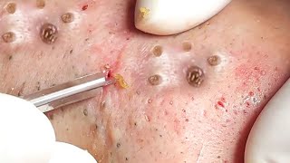 big deep blackhead removal on face1 [upl. by Ynavoeg]