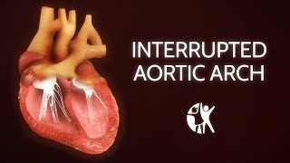 Interrupted Aortic Arch − Ventricular Septic Defect [upl. by Aneleasor]