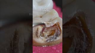 Deep caries Removal dental caries viral dentist fyp youtubeshorts smile cariesshorts tooth [upl. by Luaped]