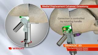 Wright  Ortholoc 3DI Flatfoot System [upl. by Leodora]