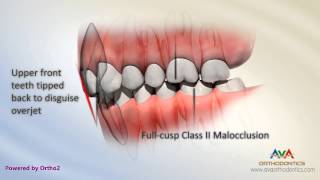 Malocclusion  Class II Div 2 [upl. by Eytak]