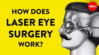 How does laser eye surgery work  Dan Reinstein [upl. by Inimod]