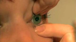 SOClear Contact Lens Removal [upl. by Malvina]