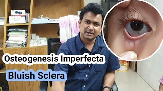 Osteogenesis Imperfecta  Bluish Sclera  Dr Abdullah Al Rafi [upl. by Armilla]