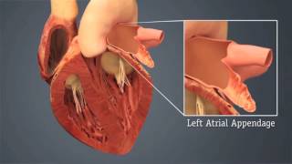 St Bernards HeartCare Watchman Procedure  Dr Devi Nair amp Patient Charles Frierson [upl. by Spanjian217]