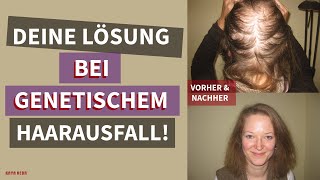 Erfolgreiche Behandlung von genetisch bedingtem Haarausfall mit Kaya Veda Produkten [upl. by Margalo]