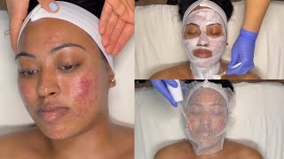 CYSTIC ACNE TREATMENT  WALKIN FACIAL FOR GRADE 3 AND 4 ACNE WITH PRO TIPS  LICENSED ESTHETICIAN [upl. by Kcirdderf]