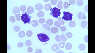 TProlymphocytic Leukaemia TPLL [upl. by Eniamrehs421]