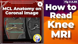 Fig 3A05 Medial Collateral Ligament Anatomy Knee MRI coronal and axial images [upl. by Inatirb34]