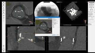 3Mensio CT precase planning ValveinValve TAVR in PerimountMagna Surgical Aortic Valve SAV [upl. by Andaira343]