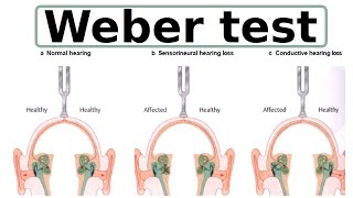 Weber test [upl. by Lilas]