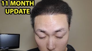 11 MONTH 2ND HAIR TRANSPLANT RESULT WITH 3500 GRAFTS BEST HAIRLINE EVER [upl. by Htilil]