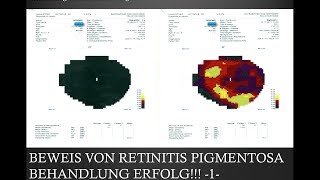 Gesichtsfeldtests 1 Retinitis Pigmentosa Behandlung FIRATLI KLINIK [upl. by Hubert]