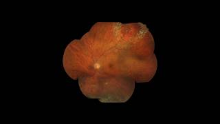 Horseshoe retinal tear with laser barrage [upl. by Trudy]