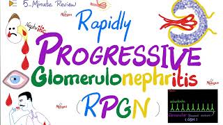 Rapidly Progressive Glomerulonephritis RPGN  Cresenteric  Nephritic Syndrome Subtypes [upl. by Tegdirb512]