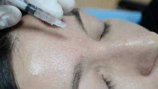 Nevus  removal method of radiowave surgery [upl. by Mariya526]