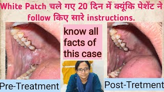 White Patch inside cheekWhite Patch चले गए 20 दिन में क्यूंकि पेशेंट ने follow किए सारे instruction [upl. by Erot]