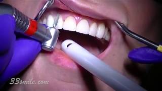 Replacing old porcelain dental veneers before and after [upl. by Ocana]