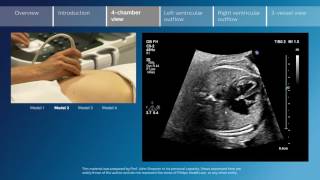 Key screening views of the fetal heart  Part 3  4chamber view [upl. by Lisetta129]