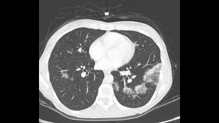 CT CHEST V11 CARDIOGENIC PUL EDEMA EOSINOPHILLIC PN SEPTIC EMBOLI AND BRONCHOPNEUMONIA lungs [upl. by Yssis]