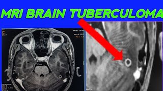 MRI BRAIN TUBERCULOMA CASE How to diagnose TUBERCULOMA in Mri Brain Tubercloma case [upl. by Tarsuss]