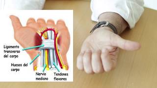 SÍNDROME DEL TUNEL CARPIANO  ¿Qué es Síntomas Diagnóstico Tratamiento [upl. by Tirrell460]