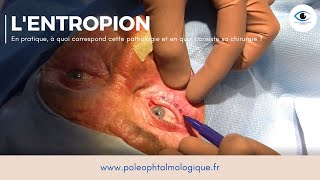 Chirurgie de lentropion Pole ophtalmologique [upl. by Kenyon499]