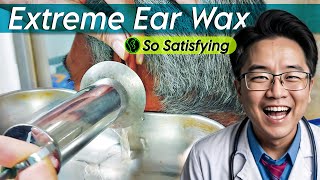 Extreme Ear Wax Removal earwaxremoval earwaxremoving earwax [upl. by Gnurt]