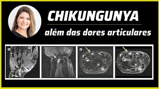 CHIKUNGUNYA  ALÉM DAS DORES ARTICULARES [upl. by Rolo]