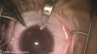 Implantation of EVO Visian ICL [upl. by Favianus]