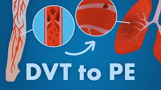 How DVT cause Pulmonary embolism within a minute [upl. by Pip536]