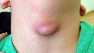 Inflamed Thyroglossal Cyst [upl. by Spada]