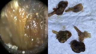 164  Plugged Ear Wax amp Dead Skin Removed from Narrow Entrance Ear using the WAXscope®️ [upl. by Atileda]