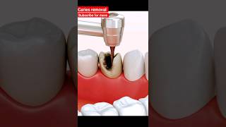 caries removal shorts viral asmr [upl. by Sebastiano]