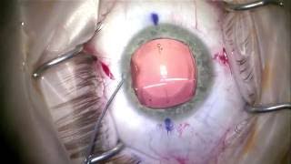 Implantable Contact Lens ICL Procedure [upl. by Ardell]