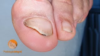 Flat foot nail cleaning [upl. by Syah]