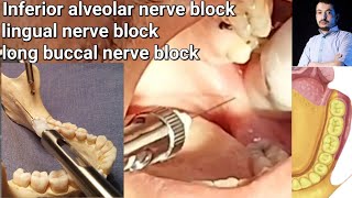 Local Anesthesia Inferior Alveolar Nerve block amp long buccal Nerves block Mandibular nerve block [upl. by Nevah790]