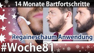 Bartwuchs Verbesserung  Regaineschaum Anwendung  3000 Abos  Das Minoxidil Experiment Woche81 [upl. by Simmons571]