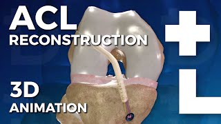 ACL reconstruction  anterior cruciate ligament surgery  Dworska hospital® [upl. by Creamer]