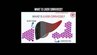 What is liver cirrhosis liver cirrhosis livercirrhosis hepatology [upl. by Rhoads]