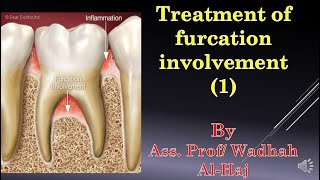 45Periodontal surgery14 Furcation involvement1Dr Wadhah Periodontology lecturesد وضاح الحاج [upl. by Nilatak547]