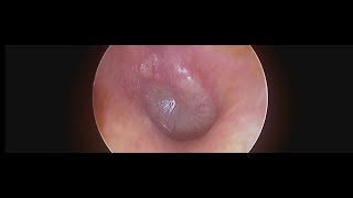 Acute Otitis Media PreSuppurative Stage with Pulsating Eardrum [upl. by Olnek]