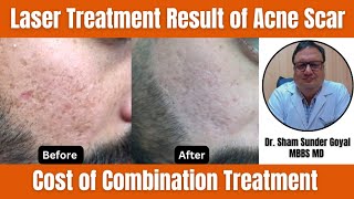 Laser Treatment Result of Acne Scar Treatment  Cost of Combination Treatment [upl. by Akemak580]